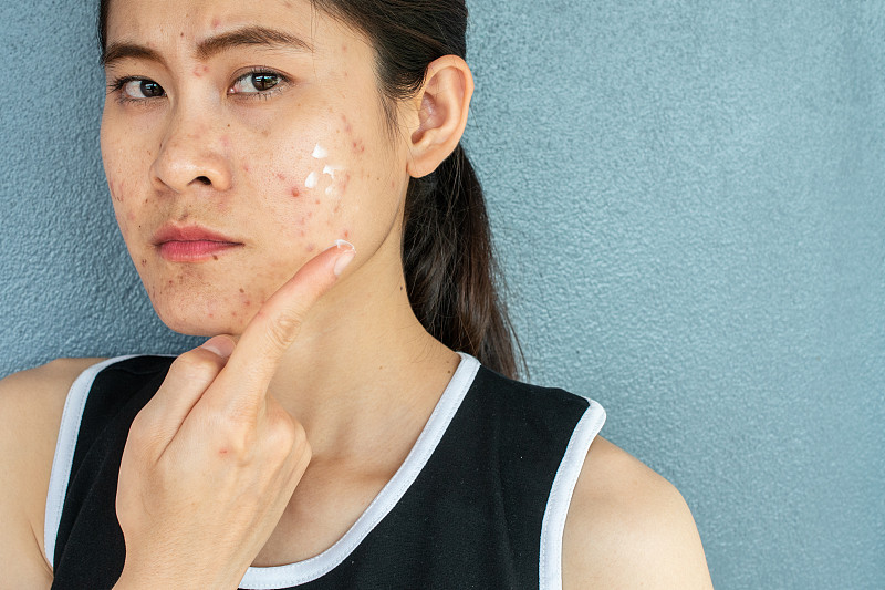 短鏡頭的女人半臉痤瘡炎癥(丘疹和膿皰)在她的臉上，她在臉上涂抹痤瘡霜治療。圖片素材