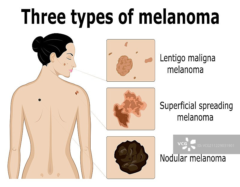 三种类型的黑色素瘤图片素材