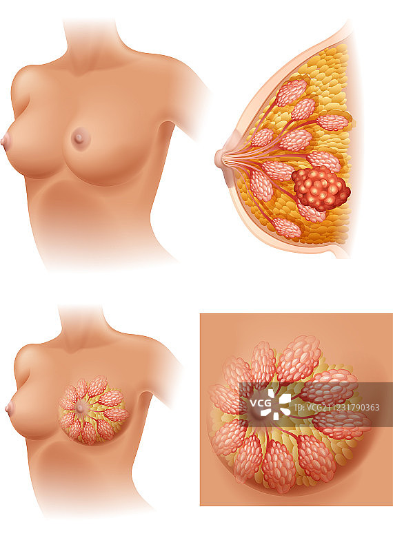 患乳腺癌的女性的图表图片素材