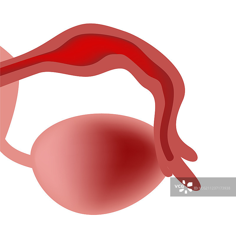 输卵管炎是指输卵管炎图片素材