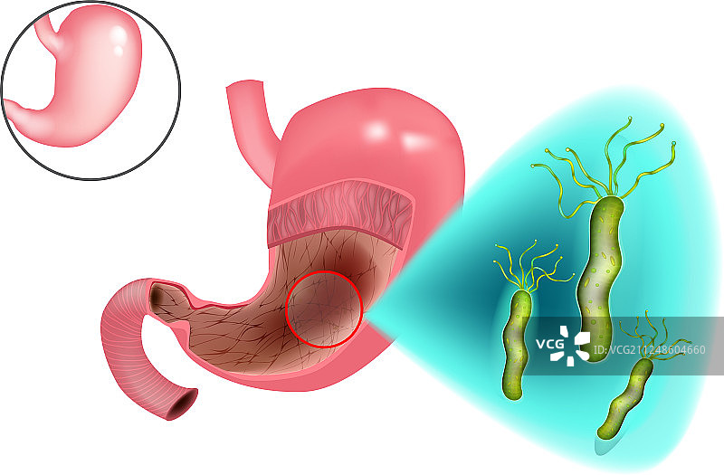 胃炎幽门螺杆菌图片素材