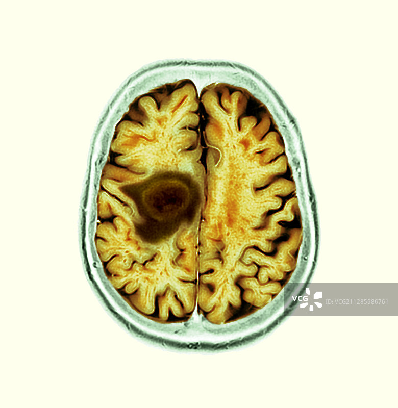 胶质母细胞瘤脑癌，CT扫描图片素材