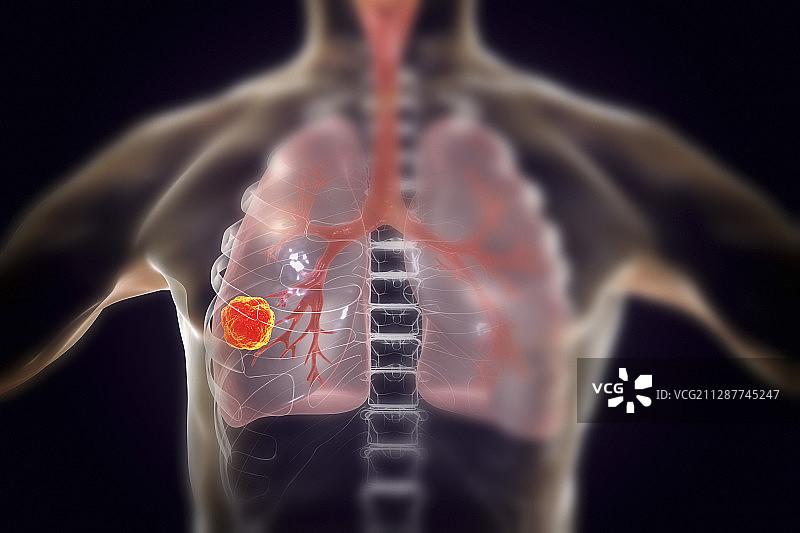 肺癌,插图图片素材