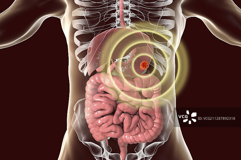 人类胃癌治疗，概念说明图片素材