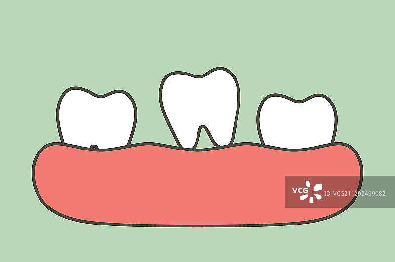 松动的牙齿-牙齿是脱落的牙龈图片素材