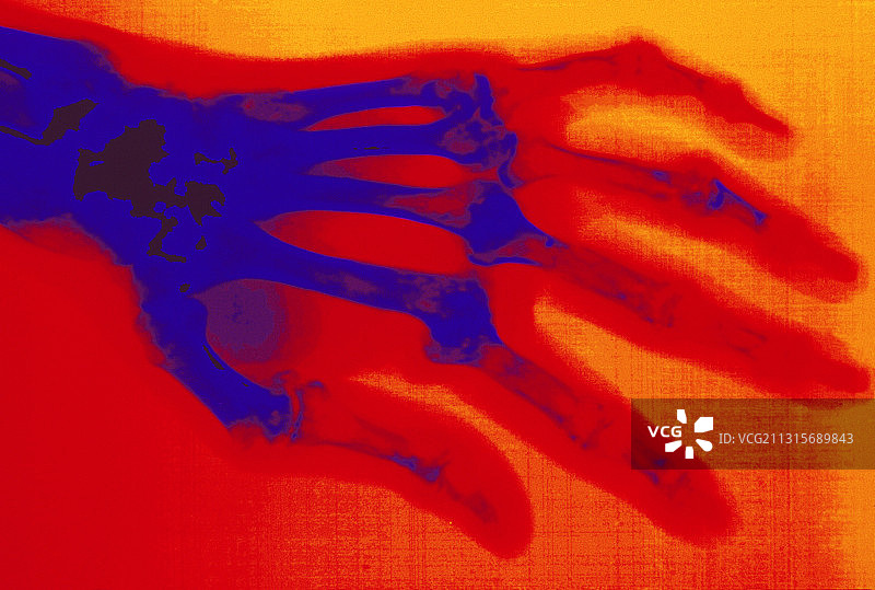 手类风湿性关节炎的x光片图片素材