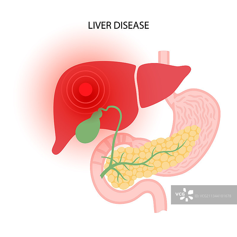 肝脏疾病的概念图片素材