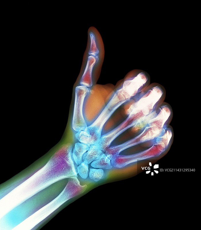 彩色x光照片显示一只手竖起大拇指图片素材
