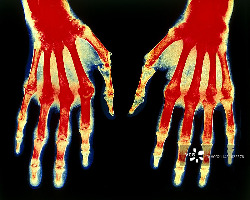 双手类风湿性关节炎x光片图片素材