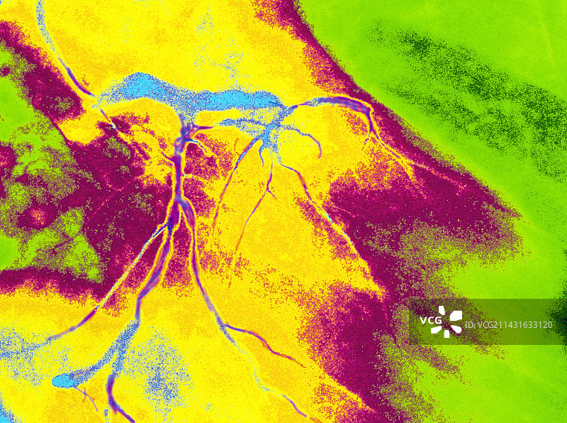 左冠状动脉狭窄彩色血管造影图片素材