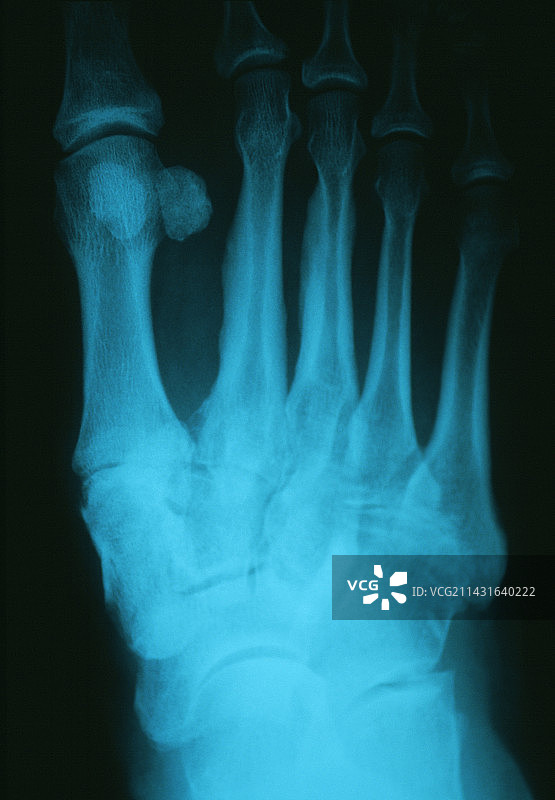 足部骨关节炎，x光片图片素材