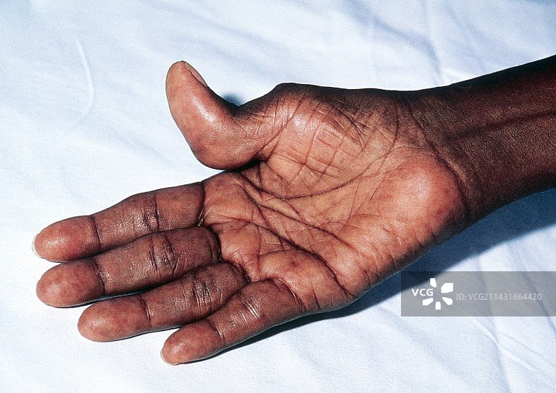 牙买加病人的手患类风湿关节炎图片素材