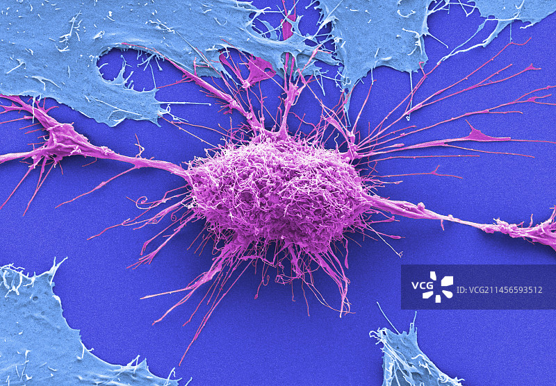 子宫颈癌细胞，扫描电镜图片素材