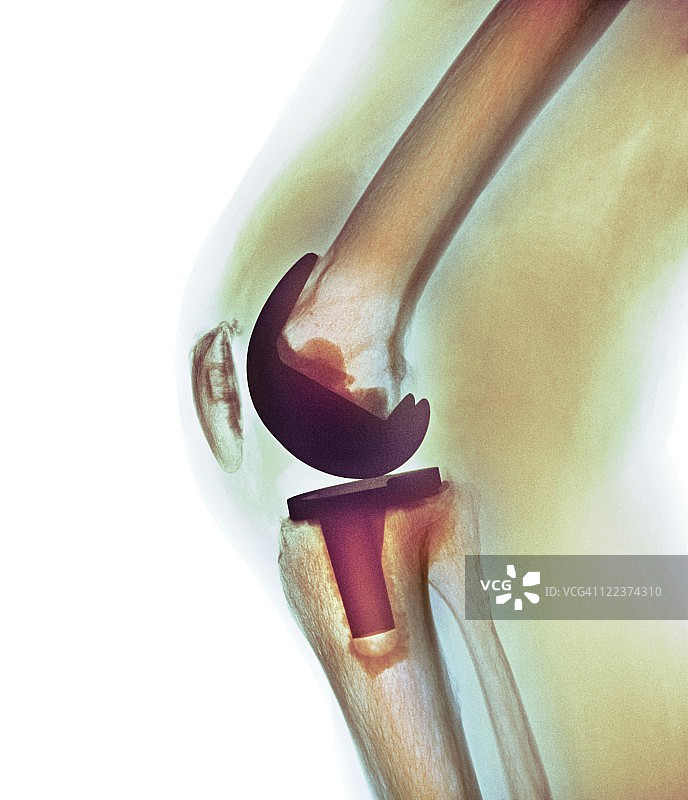 膝关节置换、x射线图片素材