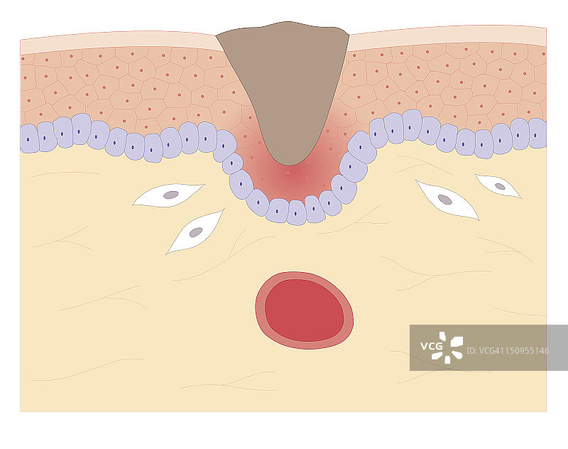 用成纤维细胞在血栓(血块)内形成塞子进行皮肤修复的横截面生物医学插图，血栓(血块)收缩，塞子收缩，下面形成新的皮肤组织图片素材