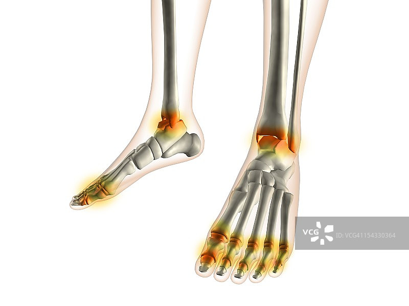 发炎的足部骨x光片图片素材