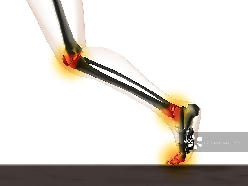 一个人的腿部x光图显示膝盖，脚踝和脚在跑步位置疼痛图片素材