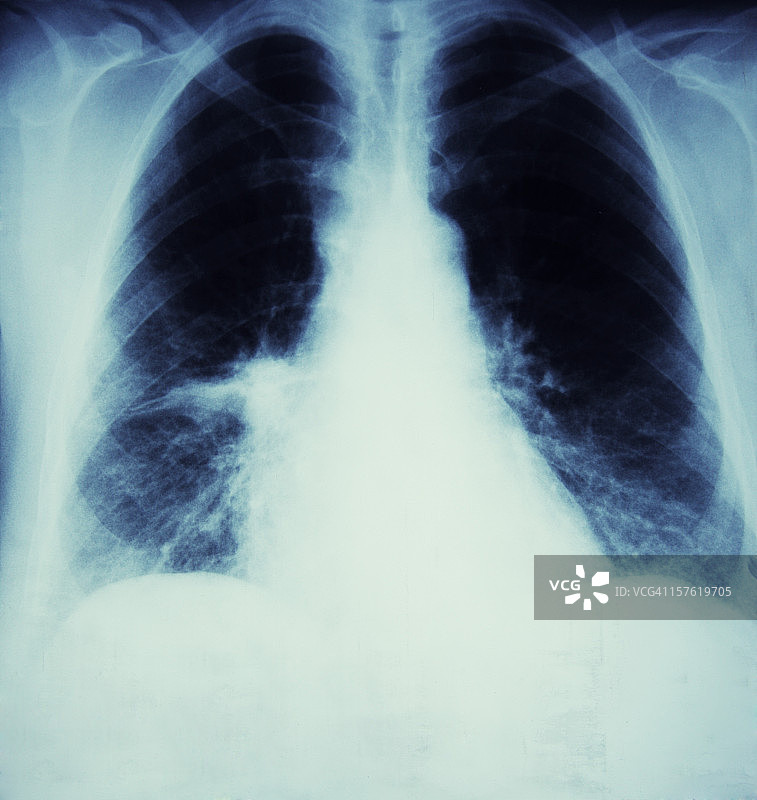 癌症和流感的x光图片素材