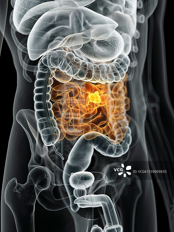 人类肠癌，插图图片素材