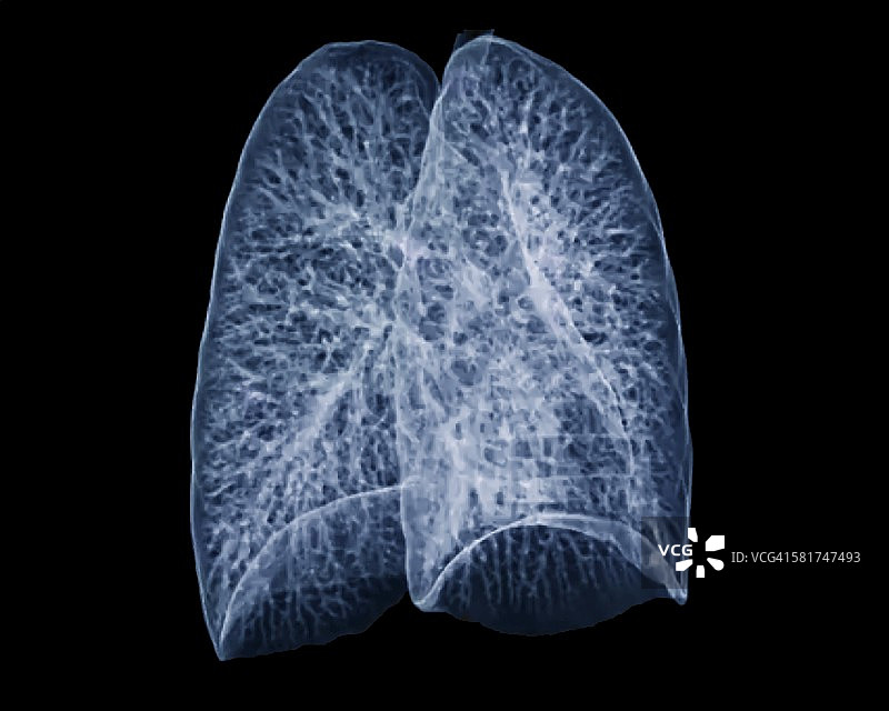 肺部健康CT扫描图片素材