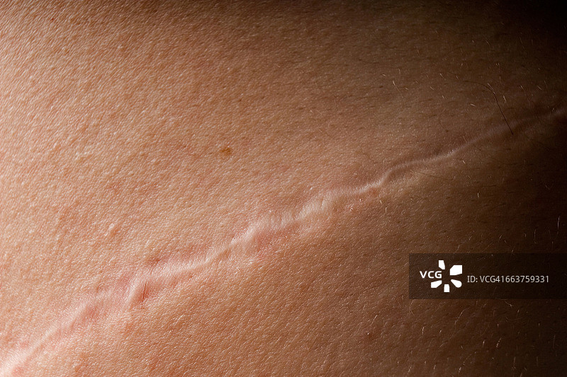 一个人皮肤上的疤痕的特写图片素材