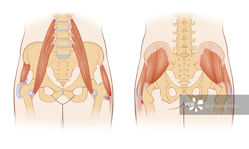 当髂腰肌肌腱半脱位于大转子或髂关节隆起时，就会发生响动髋关节综合征。经常出现在髋关节关节炎患者身上图片素材