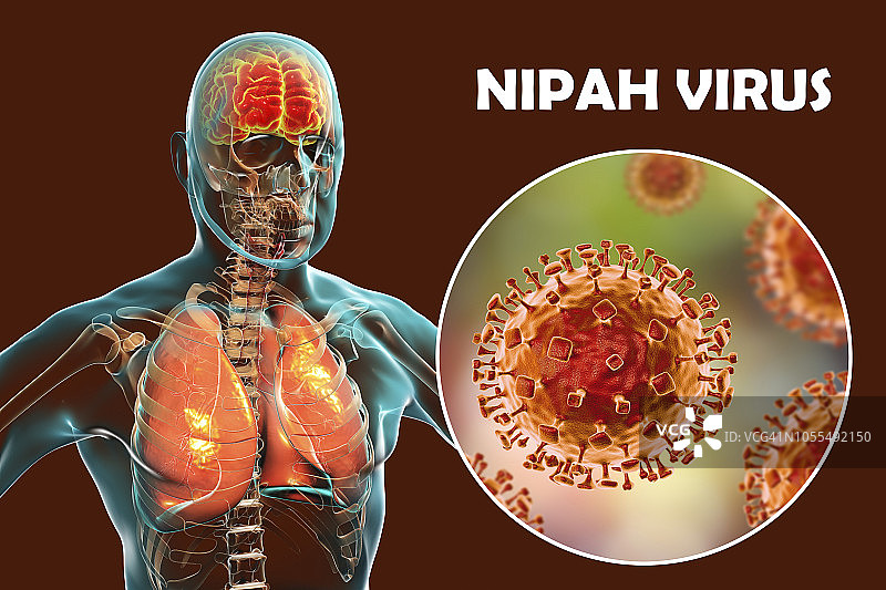 尼帕病毒引起的脑炎，说明图片素材