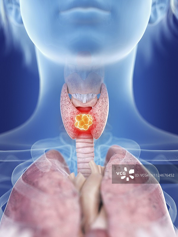 图示:一名妇女的甲状腺癌图片素材