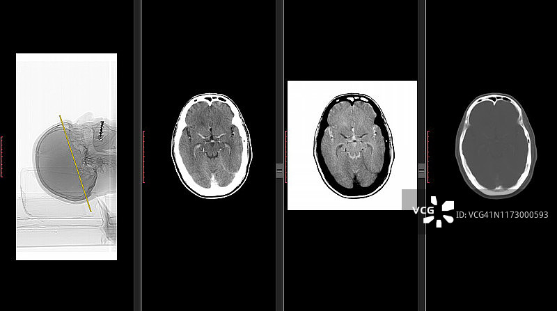 脑CT扫描(头部计算机断层扫描)高分辨率图片素材