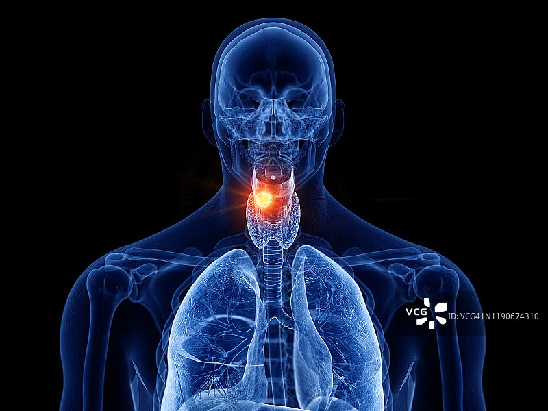 喉癌症,说明图片素材