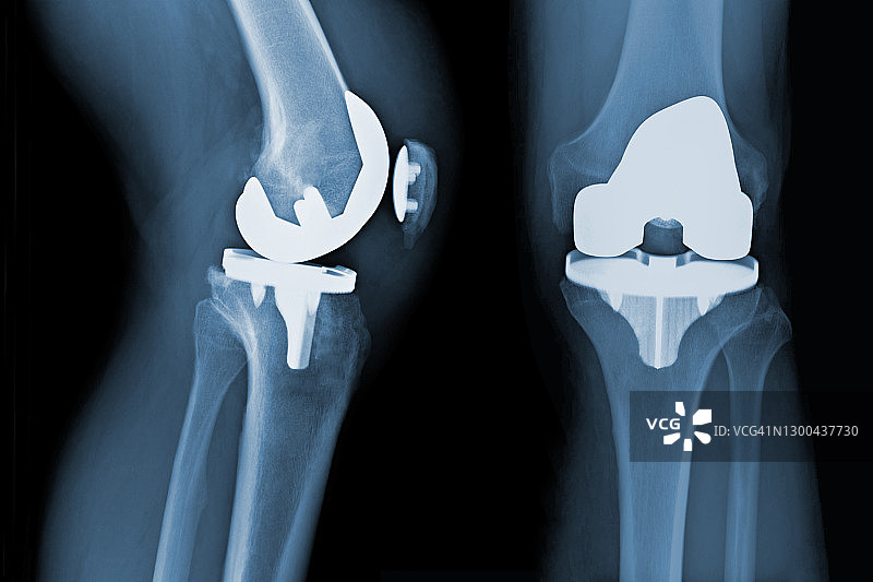 全膝关节置换术x线-骨关节炎
全膝关节置换术前x线检查-骨关节炎图片素材