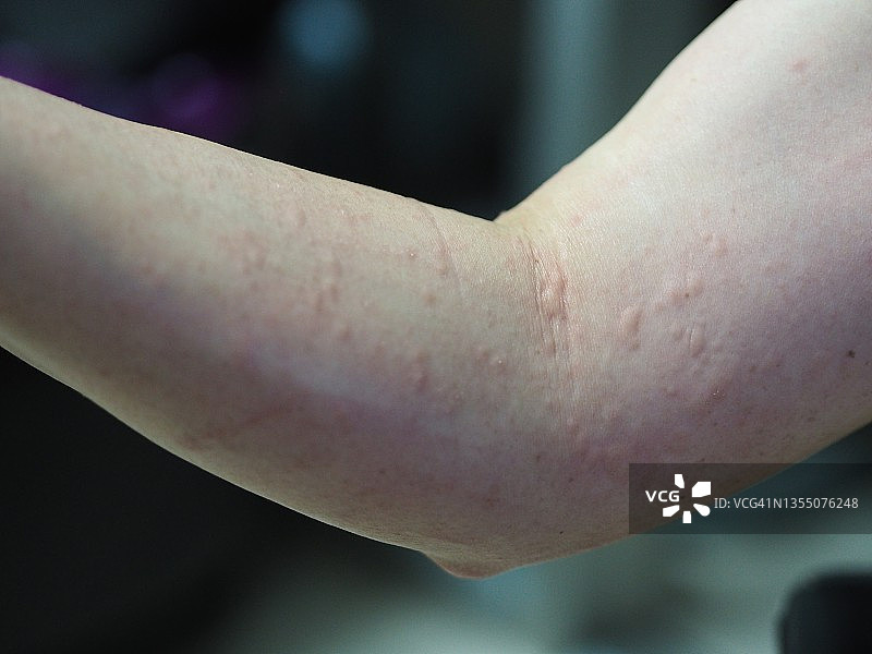 女性手臂肿胀，红色水泡，皮疹被蠕虫击中图片素材
