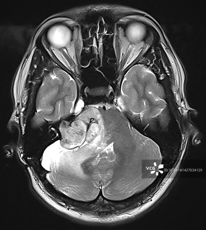 磁共振成像(MRI)在听神经鞘瘤、听神经瘤诊断中的作用，轴向T2视图图片素材