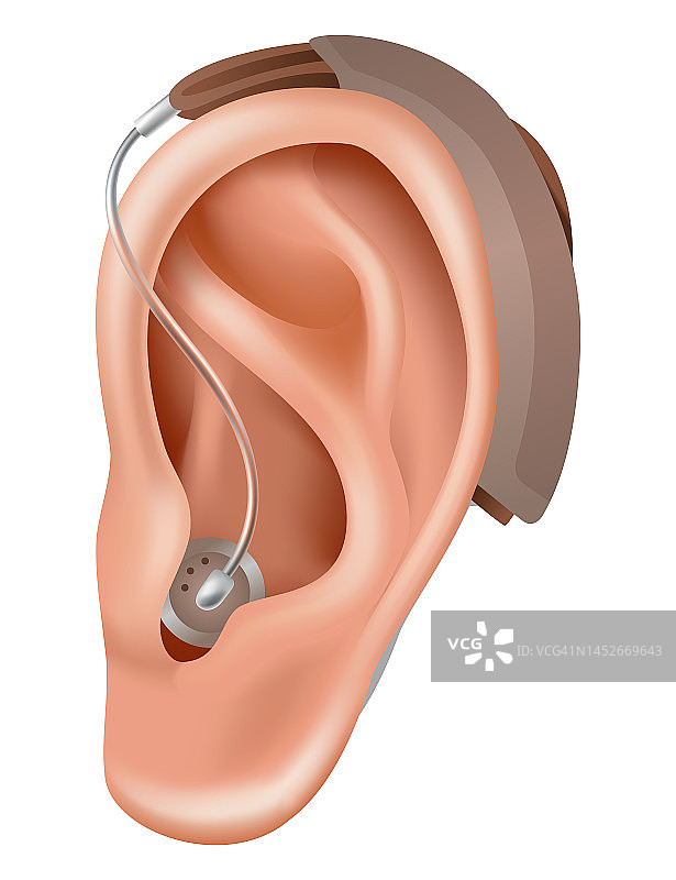 助听器。听力损失患者的扩音器。医药卫生。耳后的真实物体。耳鼻喉科治疗与义肢图片素材