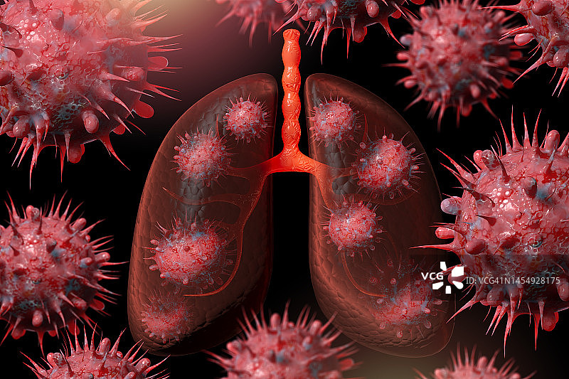 Omicron亚变种(BQ.1.1, BQ.1, BA.5, BF.7和XBB.)肺部感染，概念插图。图片素材