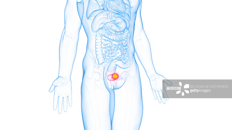 膀胱癌，插图图片素材