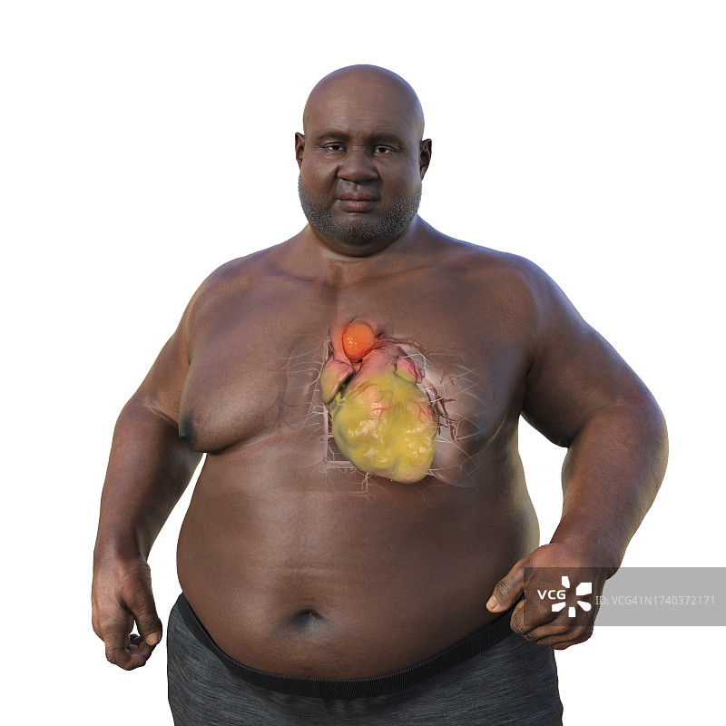 患有升主动脉瘤的肥胖男子，图示图片素材