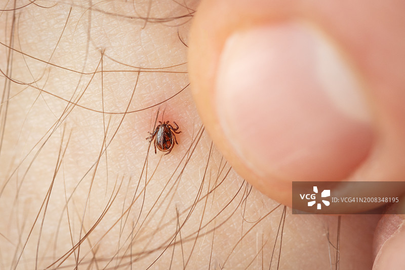 木蜱叮咬影响-皮肤发炎和发红图片素材