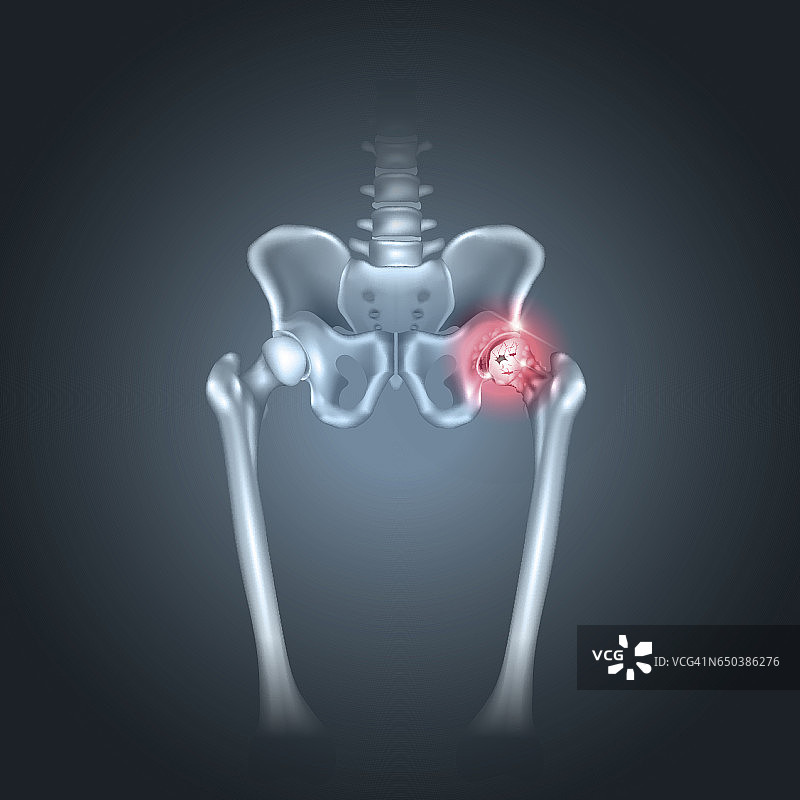 人类骨盆和臀部疼痛图片素材