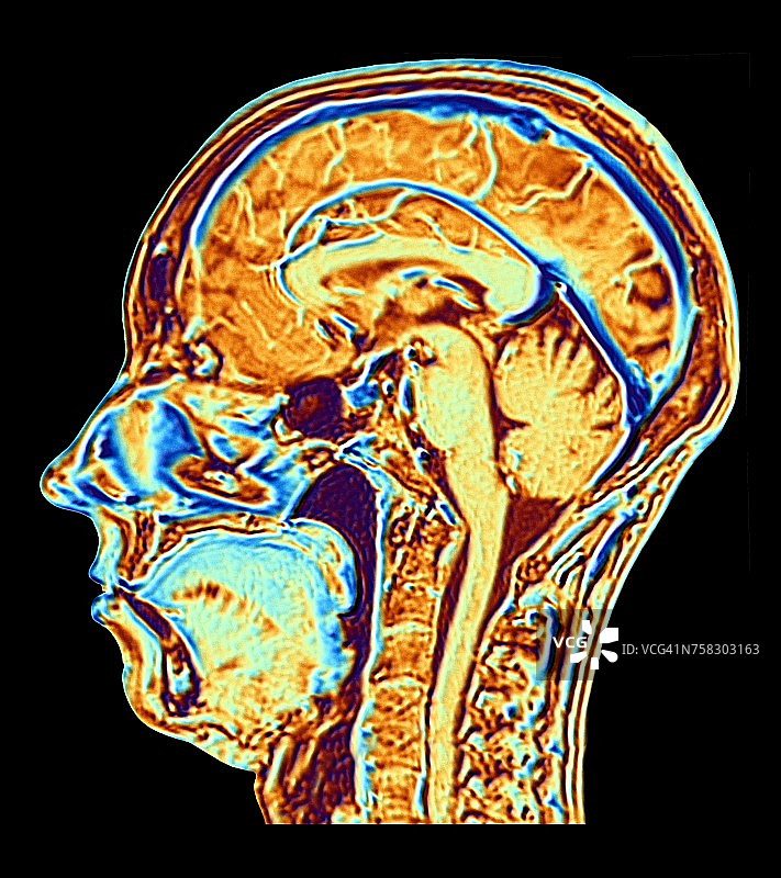 正常大脑MRI扫描，图示图片素材