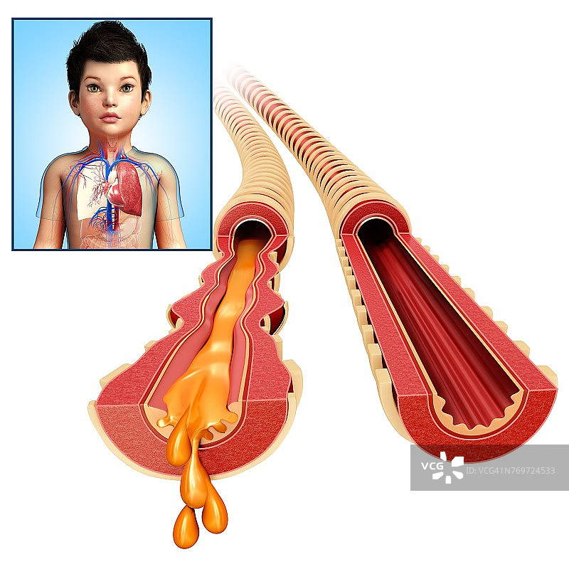 儿童支气管感染和正常，说明图片素材