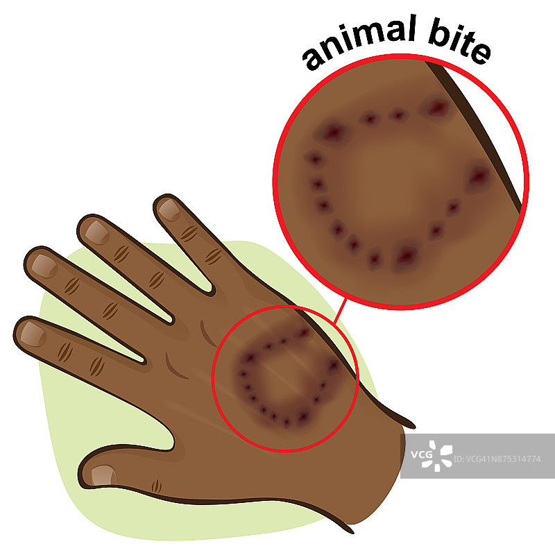 插图是人体的一部分，手带有动物咬痕，非洲血统。理想的急救，医疗和机构材料图片素材