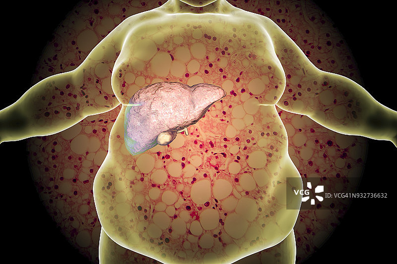 肥胖者脂肪肝的概念说明图片素材