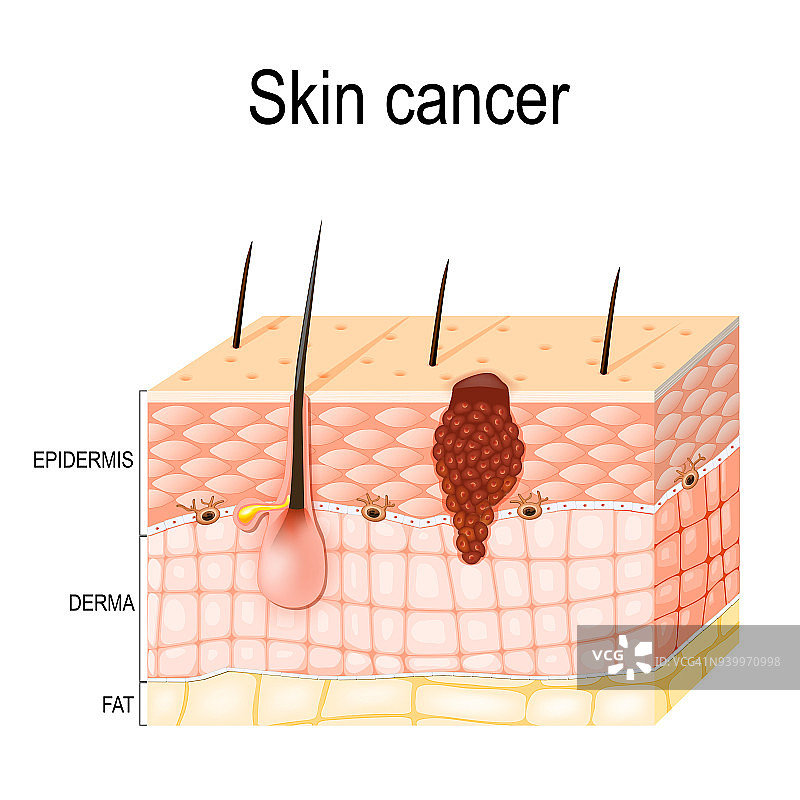 黑素瘤。皮肤癌图片素材