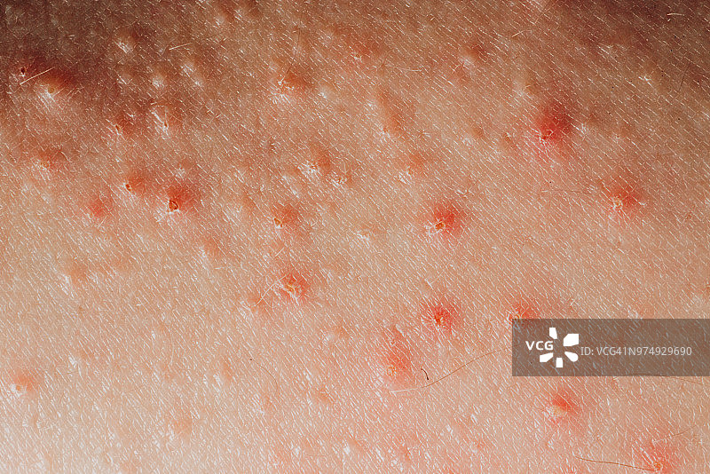 皮肤炎，湿疹，人体皮肤的病态结构图片素材