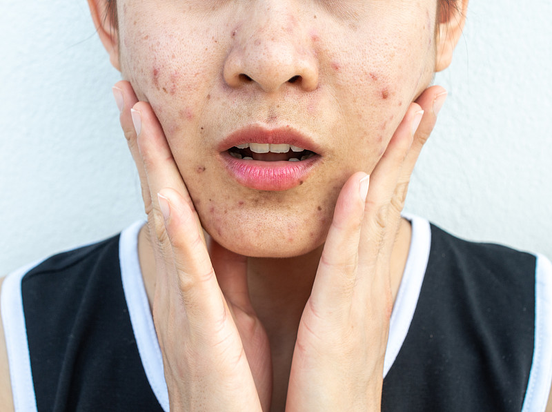 特写的女人半脸的问题痤疮炎症(丘疹和脓疱)在她的脸上。图片下载