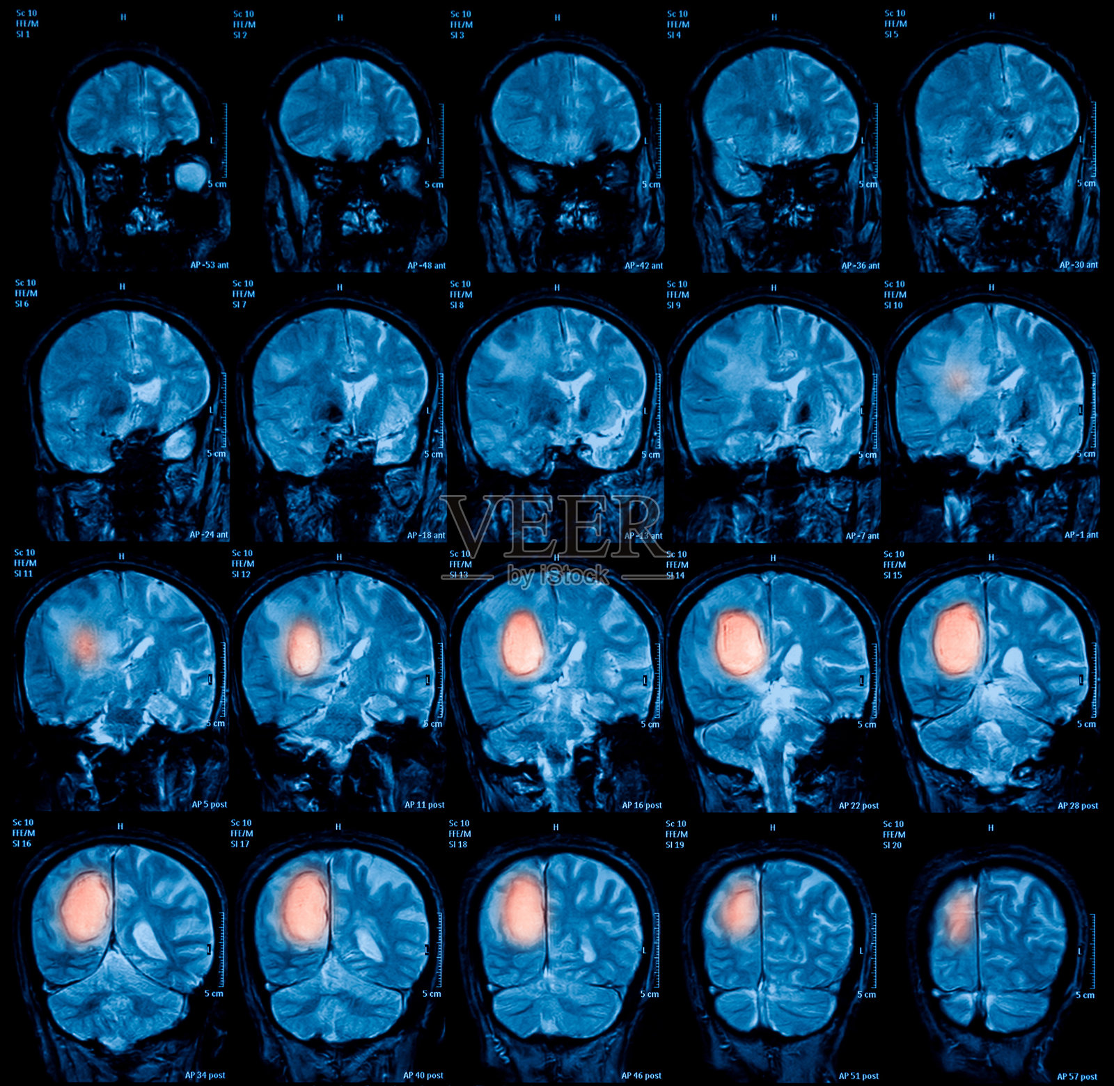 脑磁共振成像(MRI)，脑瘤照片摄影图片