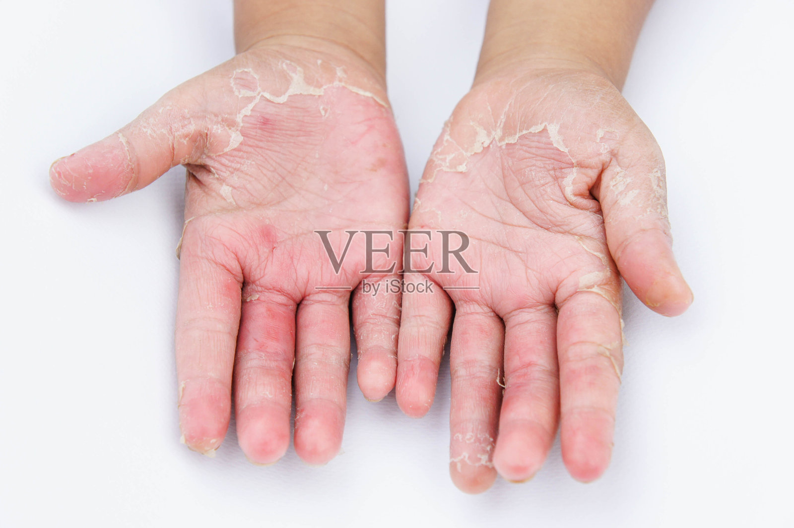 手干燥，脱皮，接触性皮炎，真菌感染，皮肤炎症照片摄影图片