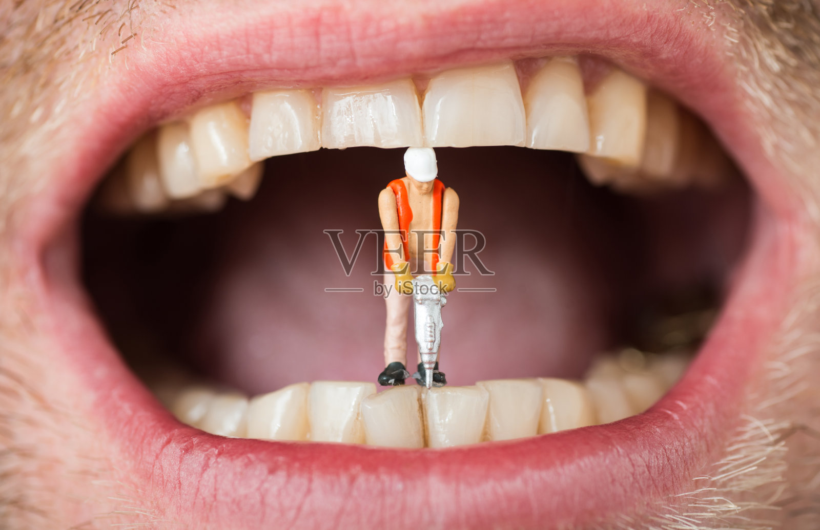 补牙用微型建筑工人牙齿上的龋齿照片摄影图片