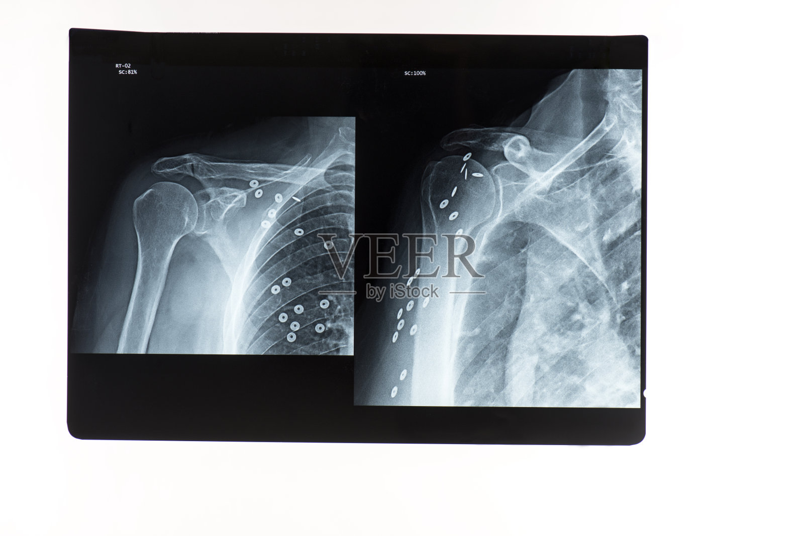 x射线的骨架照片摄影图片